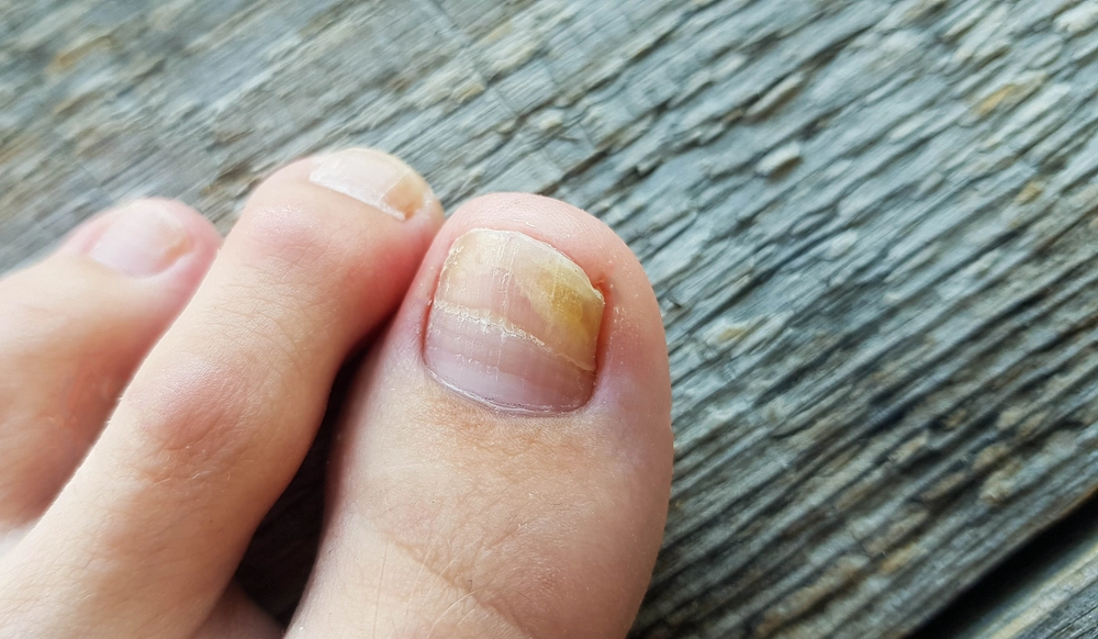 close up of a leg with a fungus on nails on a wood 2023 11 27 05 11 00 utc